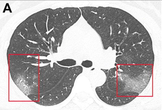 Ảnh chụp cắt lớp CT một l&aacute; phổi của bệnh nh&acirc;n Covid-19 thể hiện c&aacute;c tổn thương ở hai th&ugrave;y.